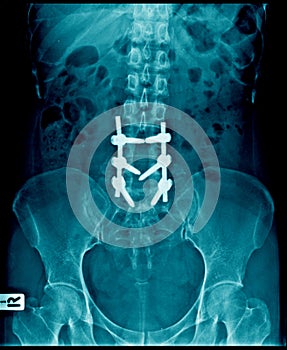 Internal fixation