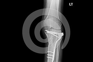 Internal of left leg fixed with plate and screws