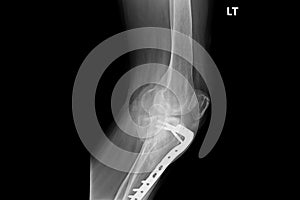 Internal of left leg fixed with plate and screws