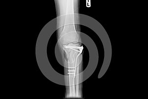 Internal of left leg fixed with plate and screws