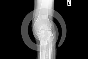 Internal of left leg fixed with plate and screws