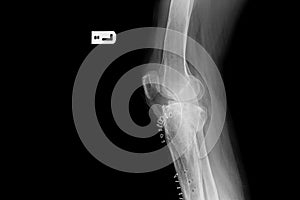 Internal of left leg fixed with plate and screws