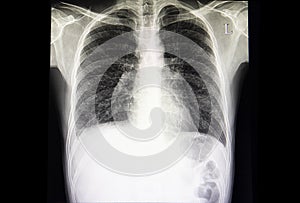 interstital lung disease with minimal pleural effusion