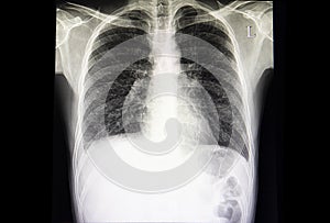 interstital lung disease with minimal pleural effusion photo