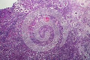 Interstitial nephritis, light micrograph