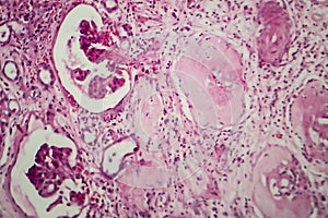 Interstitial nephritis, light micrograph