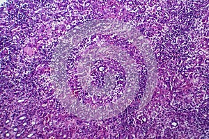 Interstitial nephritis, light micrograph