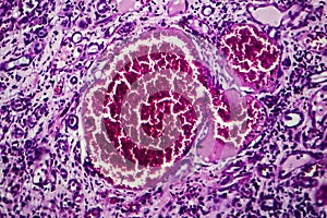 Interstitial nephritis, light micrograph