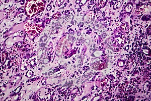 Interstitial nephritis, light micrograph