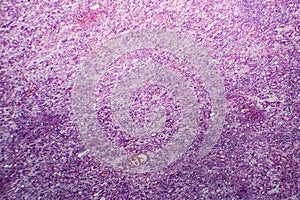 Interstitial nephritis, light micrograph