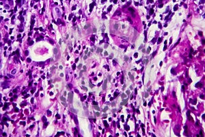 Interstitial nephritis, light micrograph