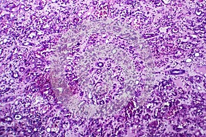 Interstitial nephritis, light micrograph photo