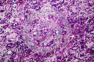 Interstitial nephritis, light micrograph