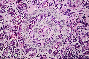 Interstitial nephritis, light micrograph