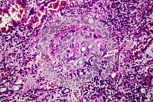Interstitial nephritis, light micrograph