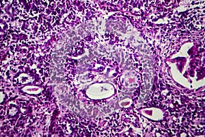 Interstitial nephritis, light micrograph photo