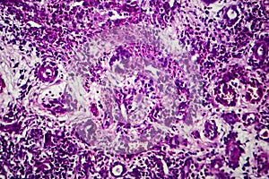 Interstitial nephritis, light micrograph