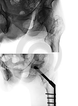 Intertrochanteric fracture femur thigh bone . X-ray of hip and comparison between before surgery upper image and after surger