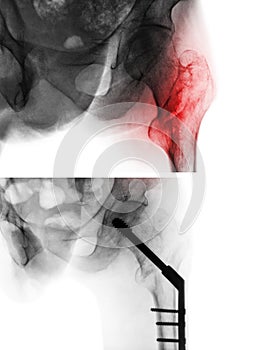 Intertrochanteric fracture femur thigh bone . X-ray of hip and comparison between before surgery upper image and after surger