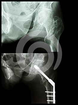 Intertrochanteric fracture left femur (fracture thigh's bone). It was operated and insert intramedullary nail.