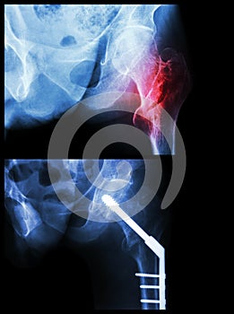 Intertrochanteric fracture left femur (fracture thigh's bone). It was operated and inserted intramedullary nail.