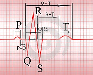 Intervals, compex of ECG