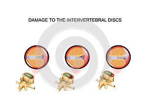 Intervertebral disc damage. vertebra