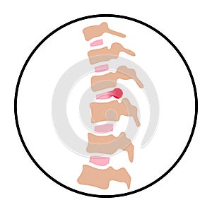 intervertebral hernia concept