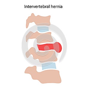 intervertebral hernia concept
