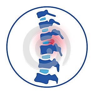 intervertebral hernia concept