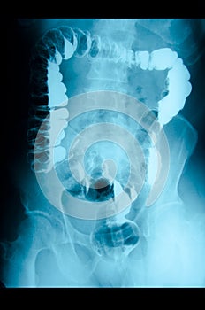 Intestinal abdominal xray