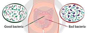 Intestinal bacteria flora. Good and bad bacterias.