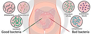 Intestinal bacterial flora. Good and bad bacterias.