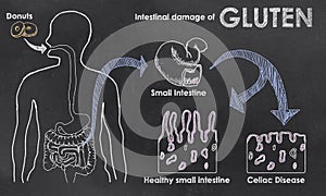 Intestinal Damage of Gluten