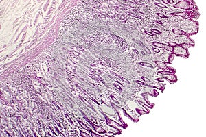 Intestinal metaplasia, light micrograph photo