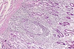 Intestinal metaplasia, light micrograph