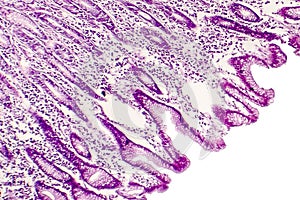 Intestinal metaplasia, light micrograph