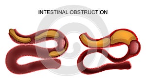 Intestinal obstruction.abdominal surgery