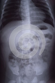 Intestinal obstruction in a child x ray
