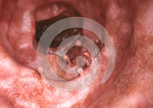 Intestinal polyps closeup - 3D Rendering