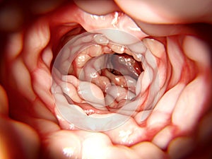 Intestine affected by Morbus Crohn photo