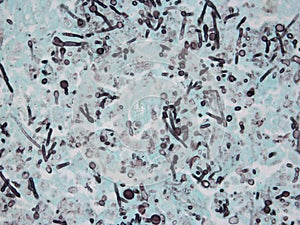 Intestine with Aspergillus Fungus (Black) photo
