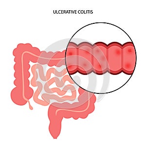 intestine ulcerative colitis