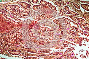 Intestine with villi and goblet cells Carcinoma tissue se