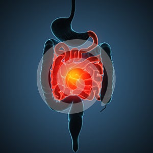 Intestines disease illustration
