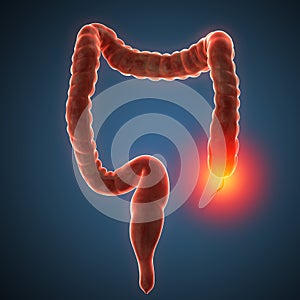 Intestines disease illustration