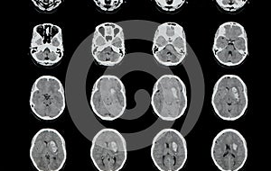 Intracerebral Hemorrhage