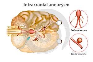 Intracranial aneurysm or brain aneurysm. photo