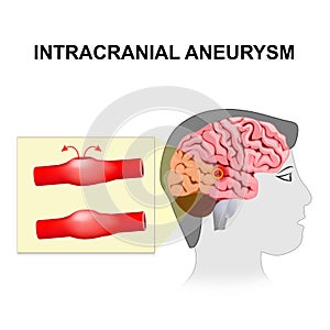 Intracranial aneurysm. cerebral or brain aneurysm. photo