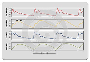 Intracranial Pressure Monitoring ICP waveform, 3d render, 2d graphic